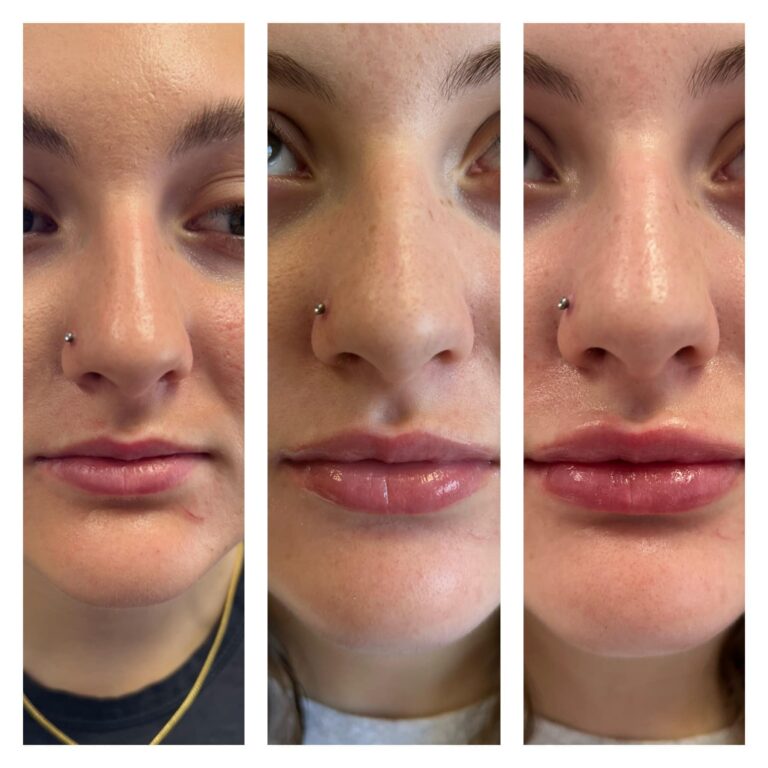 before and after lip filler 6